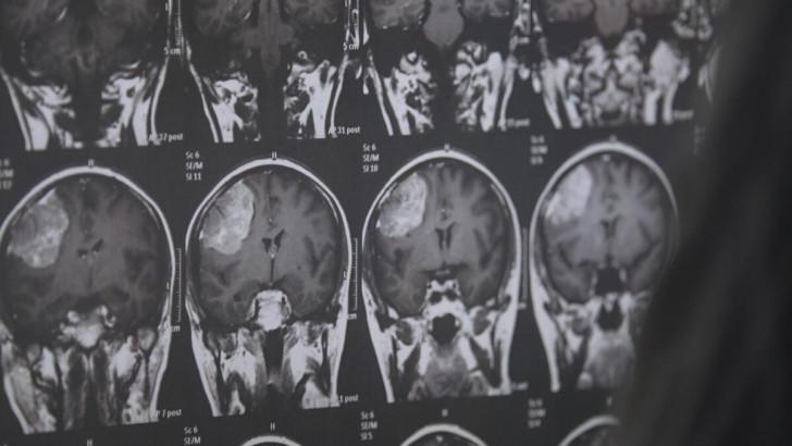 Une radiographie présentant plusieurs clichés d'un crâne sur lequel on aperçoit distinctement un méningiome